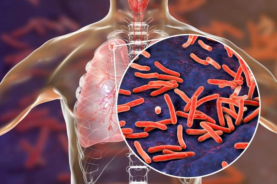 Prefeitura de Três Lagoas reforça conscientização no Dia Mundial da Tuberculose