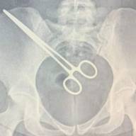 MULHER PASSA MAIS DE 2 MESES COM PINÇA NO CORPO APÓS CIRURGIA EM ARAÇATUBA